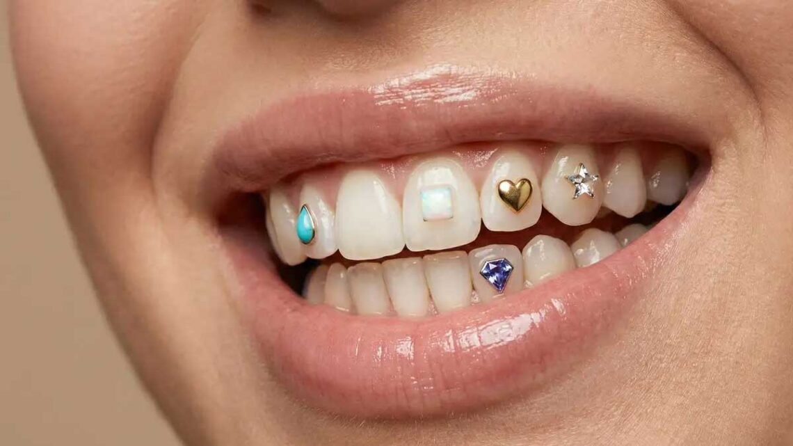 Joias dentárias